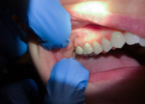 Best Emergency Wisdom Teeth Removal in Temple, TX